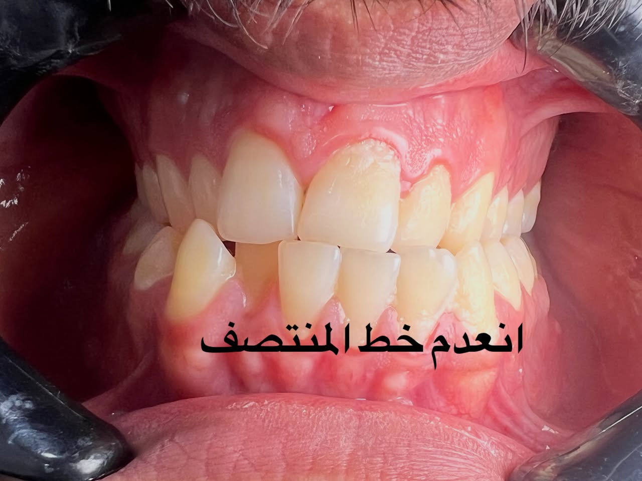 التقويم يميزنا احد حالات المعقدة و المستعصية ( الصور تتكلم عن الصعوبة) يعاني من مظهر خارجي غير متناسق غير مرغوب و انزعاجات حادة و صعوبة في تناول الطعام و اثناء الكلام بسبب الاسنان الطواحن الثلاثة في الفك العلوي مطمورة من الحالات النادرة جدا… علاج جميع الحالات الصعبة و المعقدة نتائج مضمونة خبرة طويلة في مجال الحالات المستعصية دقة في إتقان العمل ابتسامة مثالية اسعار مناسبة بالتقسيط المريح…. دكتور غزوان مزهر بغداد الكرخ نفق الشرطة بداية شارع الاطباء عيادة لوركا فوق صيدلية كنز النفق متوفر واتس *********** #تقويم_الاسنان #اطباء_تقويم_الاسنان #العضة_المعكوسة #العضة_المفتوحة #العضة_العميقة @تغليف_الاسنان_الزاركون @حشوات_الاسنان @زراعة_الاسنان @اطباء_تقويم_الاسنان @اطباء_الاسنان

نص مكتوب في الصور:
- ADAM CLINIC - ameer mouhmad التقويم يميزنا عن الصعبة و التحدي أتحدث الأسنان الطواحن الفك العلوي مطمورة
- تقدم الفك السفلي
- انعدم خط المنتصف
- طواحن الفك العلوي مطمورة
- ADAM CLINIC 2025-07-27 - ameer mouhmad طواحن الفك العلوي الثلاث مطمورة