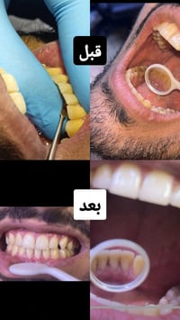 اليوم اشتغلت تنظيف وتكلسات عاشت ايدج دكتورة غدير على الشغل الراقي للي ...