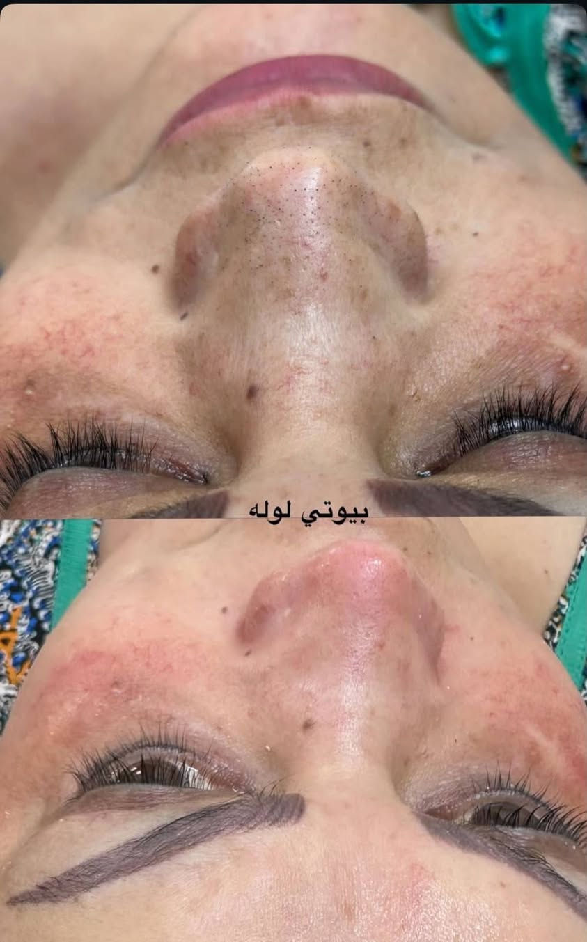 ✨ نضارة بشرتك بتبدأ من التنظيف العميق! ✨
بشرتك بتستحق عناية حقيقية مو بس شكلية. التنظيف العميق مو رفاهية، هو أساس لأي روتين عناية ناجح 
جلسة تنظيف البشره
✔️ تتخلصي من الأوساخ والرواسب
✔️ تحصلي على ترطيب عميق
✔️ تفتحي المسام وتخلي البشرة تتنفس
✔️ تسترجعي إشراقة ونضارة طبيعية

دلّلي نفسج بجلسة تنظيف بشرة مميزة، لأن بشرتك مرآتك.p

نص مكتوب في الصور:
- نظافه البشره يمي غير ✨🔥
- قبل
- بعد الجلسه تنظيف عميق وبشره تلمع بدون رؤس سوداء ✨
- لوله
- بيوتي لوله
- تجديد خلايه بشره نظيفه بدون رؤس وتلمع من النظافه 🔥 ✨