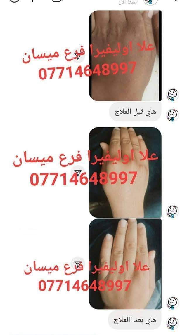 سبب حرارة الصيف واغلبيتنه راح نعاني من تشققات الاقدام وخشونتها بسبب الحراره 😞 ولا يهمكم حبايبي جبتلكم كريم علا اوليفيرا السحري المعجزه بكج كامل 🌟الي راح يخلي اقدامكم نااعمه مثل اقدام الاطفال 💎

نص مكتوب في الصور:
- +964 773 877 *********** شوفى رجلينه كلش جانت يصبن دم والله العضيم ٣ ايام خليته اله العلاج وتعالجن رجليه حتى لايده خليت صارن كلش زينات ***********97
- +964776591
- ***********
- BAN
- علا اوليفيرا!
- بان مهدي صالح
- 077
- مراسلة
- علا اوليفيرا فرع ميسان ***********
- +9647732591 *********** علا اوليفيرا ٠٥:١٧ ص بان مهدي صالح شوفي الفرق ٠٥:٢٢ ص خيه انتي رحمه من الله انطاج النه ايدج وعلاجج بي العافيه ٠٥:٢٣ ص صباح الورد ٠٥:٢٩ ص صلوات عل . محمد هآا . محمد مراسلة
- علا اوليفيرا فرع ميسان *********** هاي قبل العلاج علا اوليفيرا فرع ميسان *********** علا اوليفيرا فرع ميسان *********** هاي بعد االعلاج
- وردة
- نشط الآن
- ٧:٥٩ م
- السلام عليكم
- شخبارج
- حبيت اشوفج الفرق
- ***********
- قبل
- بعد
- علا اوليفيرا فرع ميسان
- ربي يرزقكم ان شاء الله
- ٨:١٩ م
- اللهم صلي على محمد وآل محمد
- لقد قمت بالرد على وردة
- وعليكم السلام ياقلبي
- Aa
- +964 77 2599
- ايي هم نسيت ٠٩:٣٤ م
- ***********
- هاي رجليه اليوم ٠٩:٣٤ م
- بعد استخدام مره وحده ٠٩:٣٥ م
- احسن صار ٠٩:٣٥ م
- صارن ٠٩:٣٥ م
- لصق
- مرحباً! أنا استعمل واتساب. +964 77 علا اوليفيرا فرع ميسان *********** اللهم صلي على محمد وآل محمد اخذت صوره من كلتيلي قبل ماستخدم الخلطه وعلي جان اليل ماينام من الوجع كلساعه يذب عليهن ماي لان يبسن ويشككن بس يدوس بلكاع يطكن دم وعلي نندعيلج وهوه يكول ادعي للمربه لسوتلي رجليه زينات علا اوليفيرا فرع ميسان *********** ياعمري ان شاءالله اكون عند حسن ظنكم يارب ومليون عافيه الكم ياعمري احلى شعور من تراسلوني وانتم فرحانين مراسلة
- علي اولفيرا فرع
- ميسان
- شوفي النتيجه