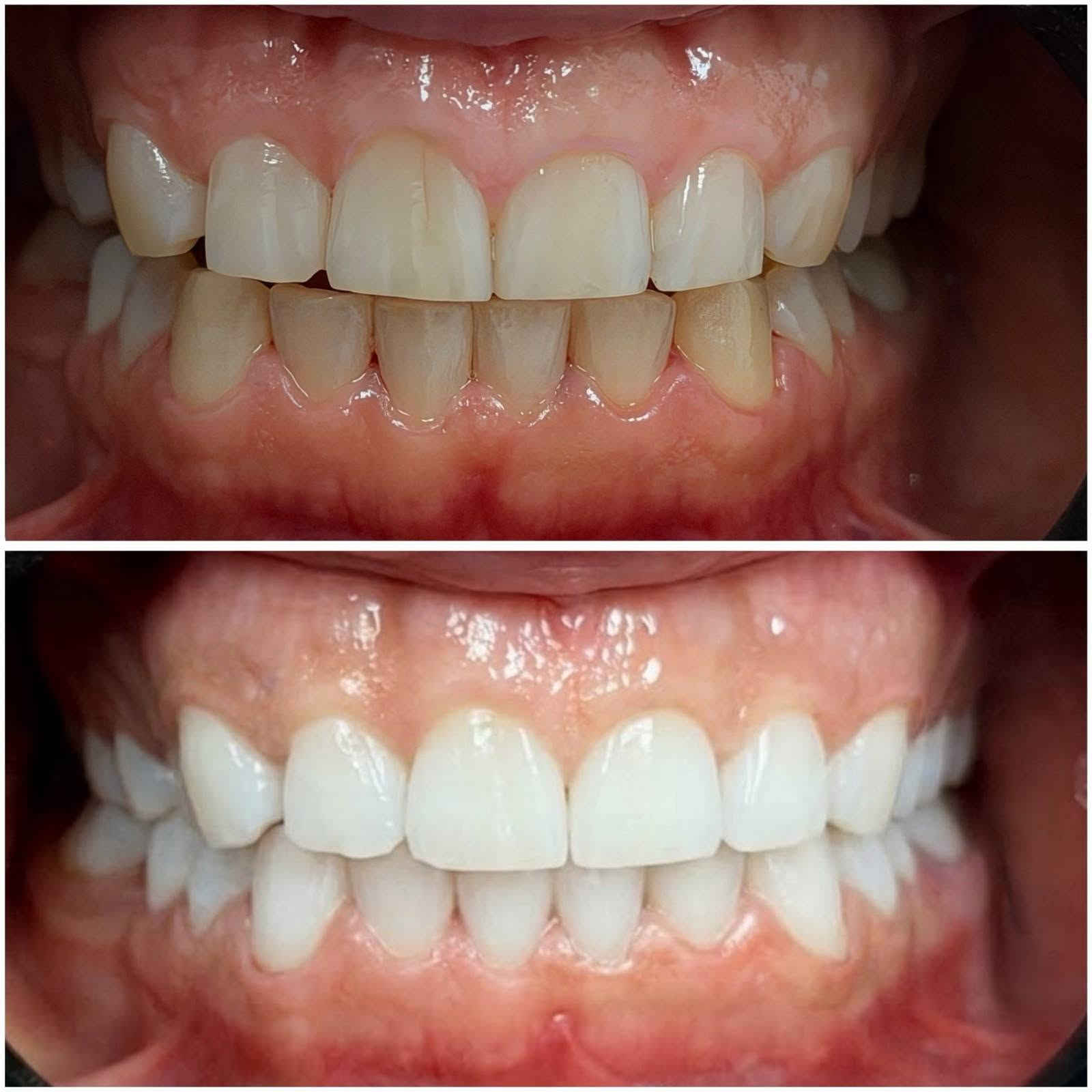 🎉 أسبوع تبييض الأسنان المجاني 🎉
لا تفوّتوا الفرصة! 😍
باشروا بالحجز من هسه 📲

📍 العنوان: داخل مجمع بسماية السكني
🏢 بناية دار المعرفة – عمارة مطعم سندريلا

📞 للحجز والاستفسار:
***********

🔥 وعروض جديدة ومميزة بانتظاركم!
⏰ انتظروها اليوم العصر… تنزل قريباً 👀✨

🦷 عيادة الزين لطب الأسنان — ابتسامتك تهمنا 🤍 داخل مجمع بسمايه السكني  بنايه دار المعرفه.       عماره مطعم سندريلا عياده الزين للاسنان الاسنان
