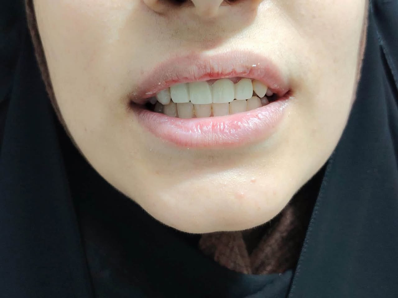 عيادة برلين • زراعة أسنان • خصم ٤٠٪