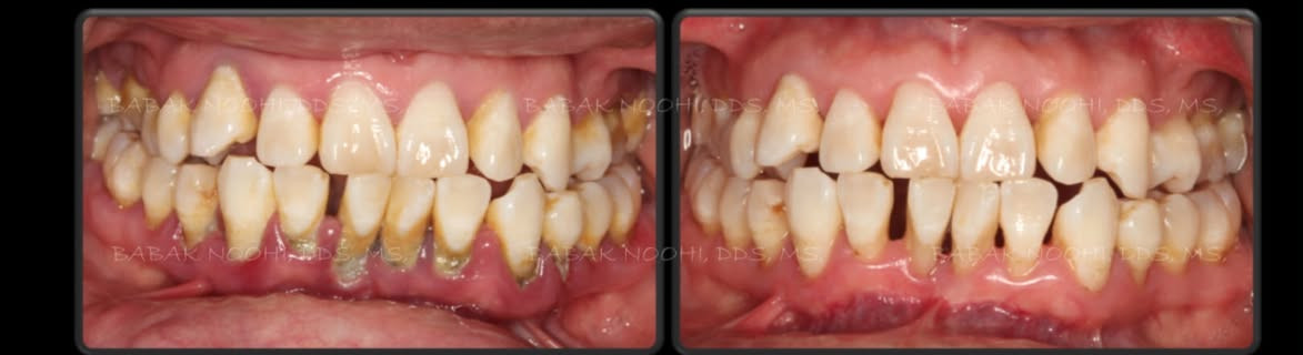 علاج مجاني • قلع أسنان • حشوات جذور