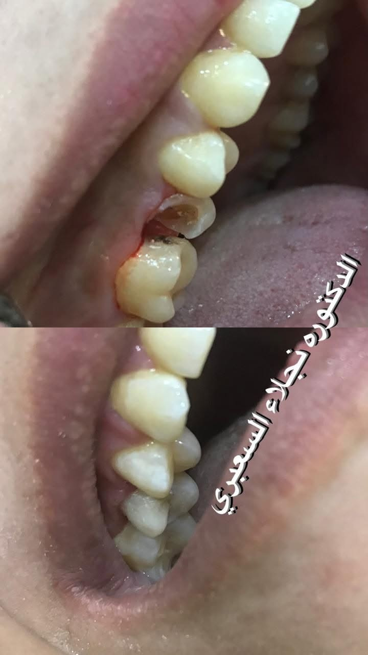 ترميم سن • تجميل اسنان • عيادة نجلاء