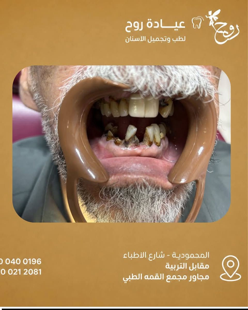 عياده روح لطب وتجميل الاسنان 
د.زهراء صادق 
وراء كل ابتسامة جميلة… قصة بدأت بالألم.

هذه الحالة وصلت وهي تعاني من تآكل شديد وفقدان لعدة أسنان، وبعد خطة علاج مدروسة استطعنا إعادة الابتسامة والثقة للمريض.

لا تؤجل علاج أسنانك… فكل يوم تأخير قد يزيد من صعوبة العلاج.

📍عيادة روح لطب وتجميل الأسنان
المحمودية – شارع الأطباء
📞 ***********
