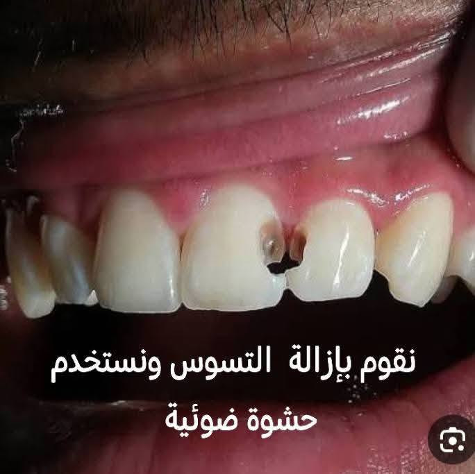 🦷 عندك حالة أسنان وتدور على علاج بسعر رمزي؟
لفترة محدودة أستقبل حالات للعمل عليها في عيادات جامعة النور التخصصية لطب الأسنان 🤍
الحالات المتوفرة حاليًا:
🦷 قلع الأسنان — 3,000 د.ع
تنظيف الأسنان — 4,000 د.ع
🦷 حشوات ضوئية — 5,000 د.ع

وعندي أيضًا حالات أطفال:
• قلع — 2,000 د.ع
• حشوة — 5,000 د.ع
• فلورايد — 2,000 د.ع
 وحالات التعويضات:
• طقم متحرك كامل لفقدان جميع الأسنان
•
أسعار الأطقم تُحدد حسب الحالة ونوع التعويض.
جميع الحالات تتم داخل العيادات التعليمية وتحت إشراف الأطباء.
📩 إذا عندك حالة أو أحد من أهلك يحتاج علاج، دزولي صورة للحالة بالخاص وأوضح لكم إذا الحالة مناسبة والتفاصيل كاملة.
🤍 واللي يعرف شخص محتاج إحدى الحالات، ياريت يدزله المنشور.
📍 جامعة النور – عيادات طب الأسنان

نص مكتوب في الصور:
- فقدان جميع الاسنان نعوضه بطقم متحرك
- Facebook ...tartar, also called dental حفظ مشاركة What is Dental Calculus? | Atlas Dental
- نقوم بإزالة التسوس ونستخدم حشوة ضوئية
- يحتاج إزالة التكلسات وتنظيف