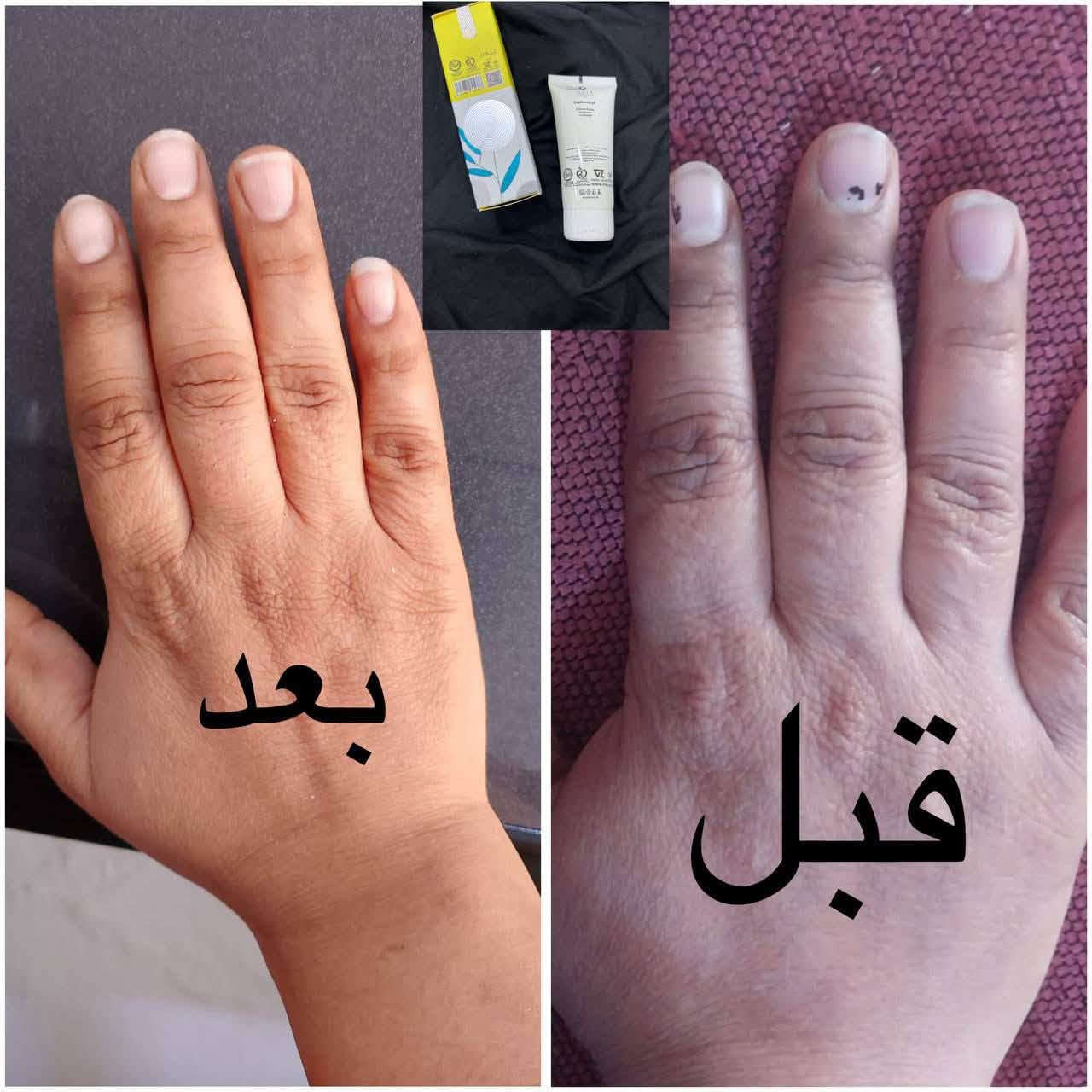 منتجات عنايه لبشره والشعرواستشاره مجانيه ***********

نص مكتوب في الصور:
- بعد
- قبل
- 3:13 عمر 25 يوم بعد التونيك (25 يوم) قبل العلاج وقبل التونيك تونيك ليدورا للأعشاب HERBAL ANTI HAIR LOSS TONIC بالأعشاب للشعر الجاف والتالف الفوائد زيادة كثافة الشعر يحد من تساقط الشعر يقوي الشعر من الجذور ينشط فروة الرأس يحسن الدورة الدموية يغذي ويصلح الشعر التالف طريقة الاستخدام ضعي كمية مناسبة على فروة الرأس النظيفة ودلكي بلطف بأطراف الأصابع حتى الامتصاص، يفضل استخدامه يومياً مرة واحدة. شامبو ليدورا للأعشاب HERBAL SHAMPOO للشعر الجاف والتالف الفوائد ينظف بلطف دون تجفيف يرطب ويغذي الشعر الجاف يصلح الشعر التالف والمتصفح يعزز لمعان ونعومة الشعر يحمي من التقصف والتكسر مناسب للاستخدام اليومي طريقة الاستخدام ضعي كمية مناسبة على الشعر المبتل دلكي بلطف حتى تتكون رغوة غنية ثم اشطفي جيدا بالماء. يناسب الاستخدام اليومي. مناسب ل: جميع أنواع الشعر خاصة الشعر الجاف والتالف مناسب لعمر 25 سنة فما فوق 100% مكونات طبيعية آمن ولطيف خالي من البارابين مستخلصات إيرانية أصلية قوة وكثافة من الجذور حكة طبيعية لشعر صحي رد