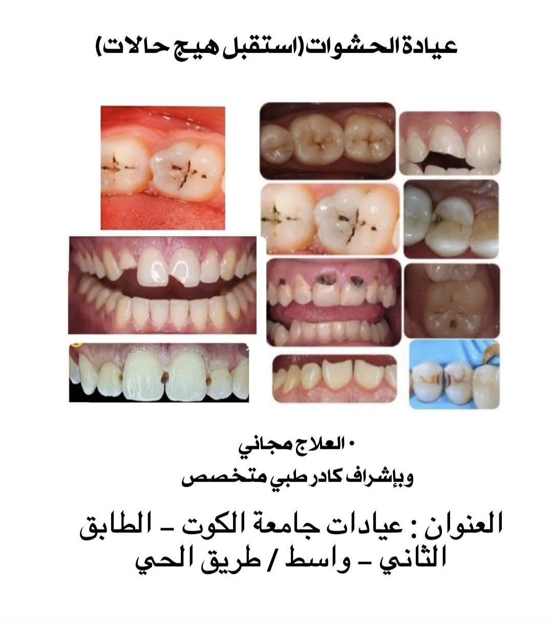 علاج مجاني • جامعة الكوت • حشوات تجميلية