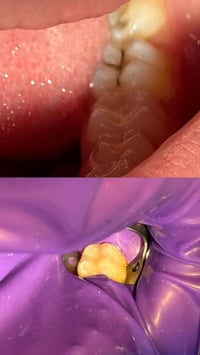 حشوات ضوئية • تجميلية • مجاني