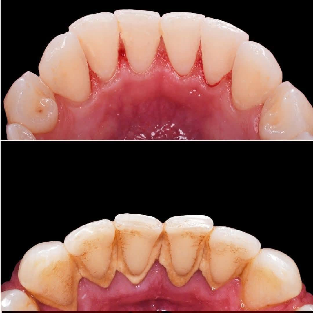 عروض الجمعه تنضيف أسنان ب20 فقط بدل 50 
الحجز على الرقم التالي ***********

نص مكتوب في الصور:
- Spudak dental group