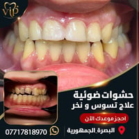 حشوات ضوئية • علاج التسوس • البصرة