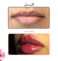 توريد الشفة • خصم نص • سنتر نونة