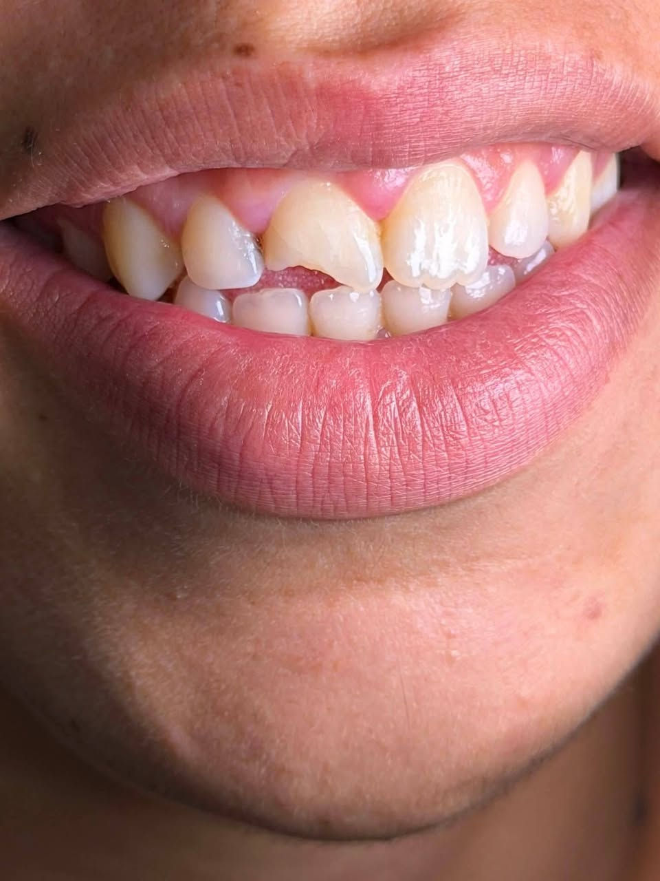 جزء من شغلنا بـ الحشوات التجميلية 🦷✨

مو بس حشوة… نرجّع شكل السن ونخليه يندمج ويا الابتسامة بشكل مرتب وطبيعي 😍

شغل نظيف وتفاصيل تفرق بالابتسامة 🤍

📍 بغداد – الأمين الثانية – شارع المهداوي
📞 *********** @highlight
