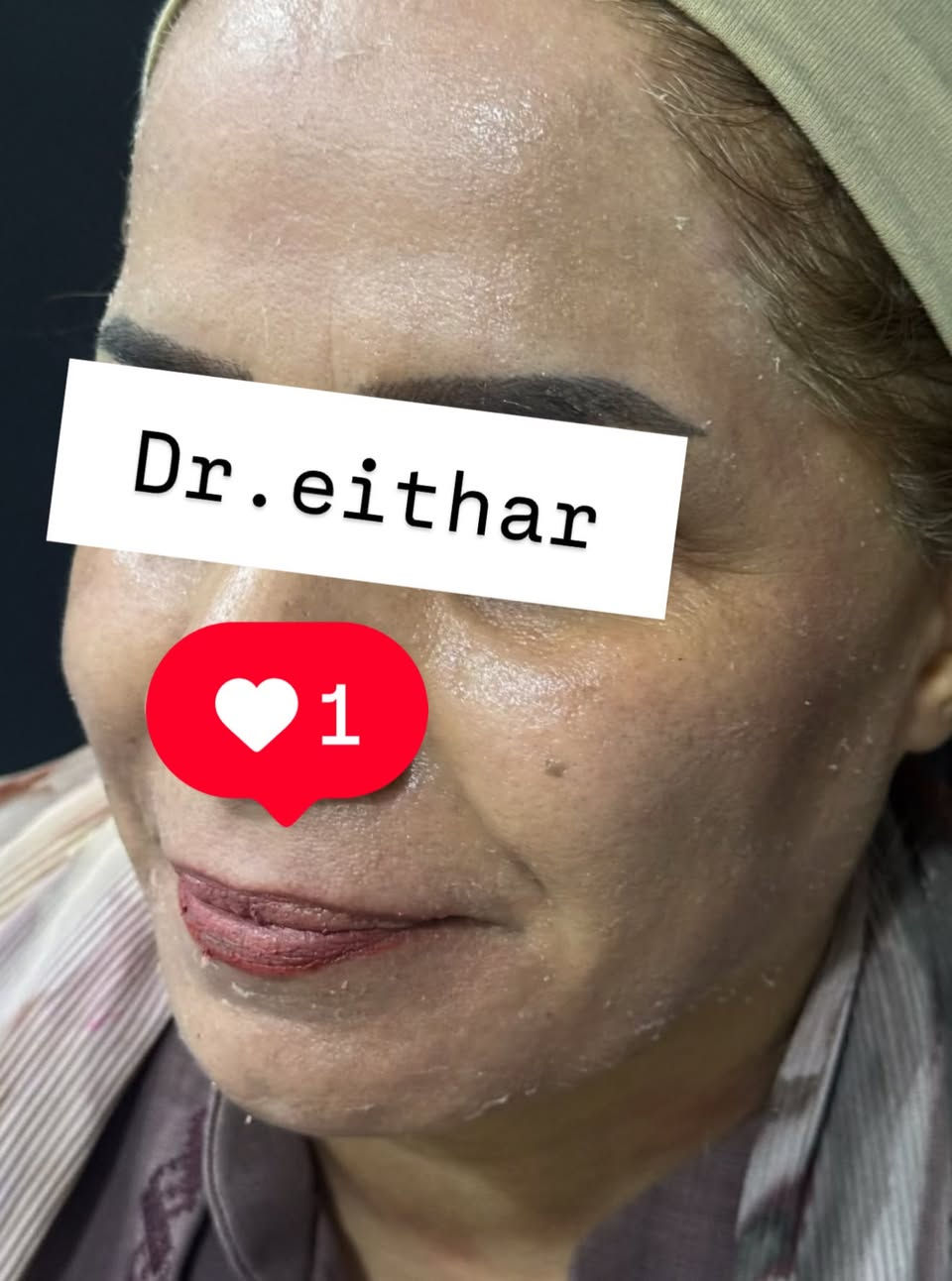 كونتور الوجه بالفلر  (لفتنك وجنات  واصداغ وتدوير الفك والذقن ونظاره وشفة وبوتوكس ) 🔥🔥
لاحضو الفرق بالذقن ومنطقه الفك   شكد تغير الشكل🔥
عروووض للكادر التدريسي والخريجات والموظفات والعروسات  ثبتتهه الكم بالستوري بالهايلايت وببوست اعلى الصفحة ✨✨

د.ايثار سامي عبد الامير
واسط الكوت الهوره مجمع القبطان طابق اول 

الحجز***********

نص مكتوب في الصور:
- Dr.eithar 1