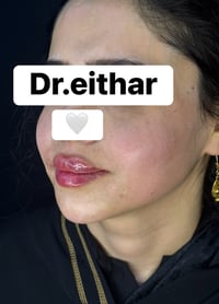 استداره الوجه • د.ايثار • واسط الكوت