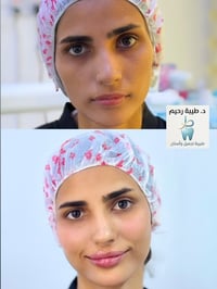 فلر شفايف • فلر وجنات • العزيزية
