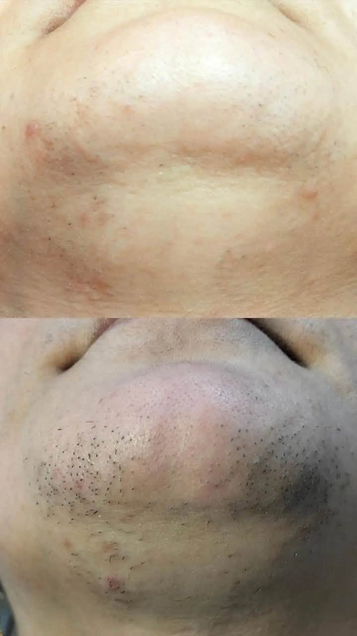 الفرق واضح ✨
جلسات ليزر تفوت للقلب مو بس للجسم.. نتيجتها من أول جلسات تحسين بالفرق الواضح؛ نعومة مثل الحرير وبشرة صافيه بدون أي شعراية مزعجة ولا التهابات.

شوفي الفرق بعينج.. الصور تحجي وحدها! الفرق بين قبل (المعاناة والتعب) وبين بعد (النعومة والراحة والدلال الحقيقي).

الموقع : الحود - مجمع الاسراء والمعراج الطبي

للحجز والاستفسار : ***********

مركز البابونج للعناية والتجميل

صفحتنا على انستگرام 

https://www.instagram.com/clinic_ri?igsi=MTVna3hyaG00amF2aA==
