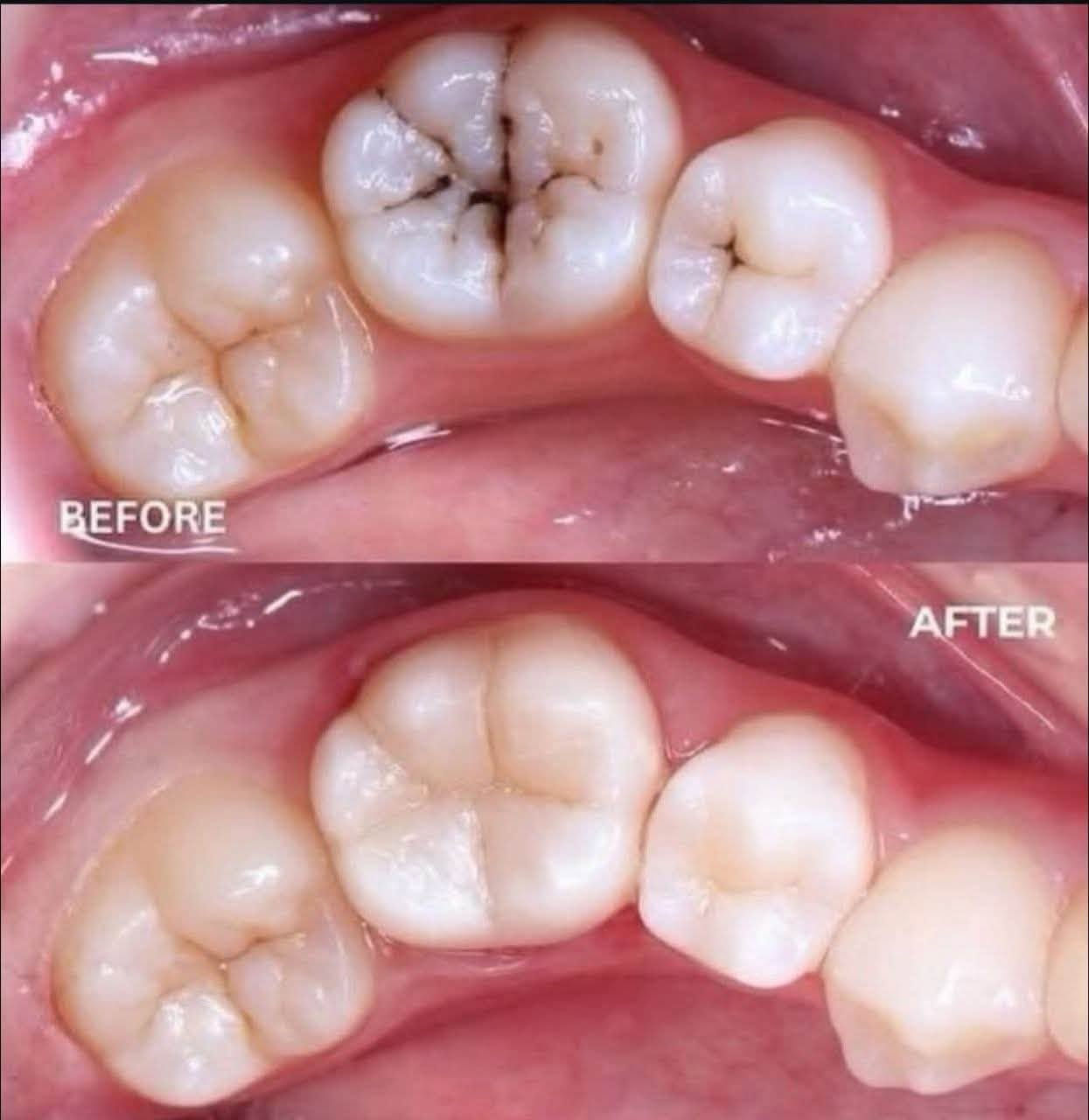 متوفر عدنا علاج الاسنان مجاناً بالكامل
تحت إشراف أطباء مختصين
خدمتنا:
حشوات للاسنان 
قلع الاسنان او الجذور المتبقية
تنظيف الاسنان 
موقعنا: كربلاء _ خلف مول الحارث_ سيطرت السعديه
للتواصل عبر الوتساب او الاتصال على الرقم
***********

نص مكتوب في الصور:
- معاً نحو ابتسامة أجمل مجاناً 1 قلع الأسنان والجذور المتبقية 2 حشوات ضوئية 3 تنظيف الأسنان 4 تعويض الأسنان بطقم متحرك الدكتور: مصطفى حيدر كربلاء - السعدية خلف مول الحارث ( عيادات بيارق العميد التعليمية ) *********** صحتك .. ابتسامتك
- BEFORE AFTER