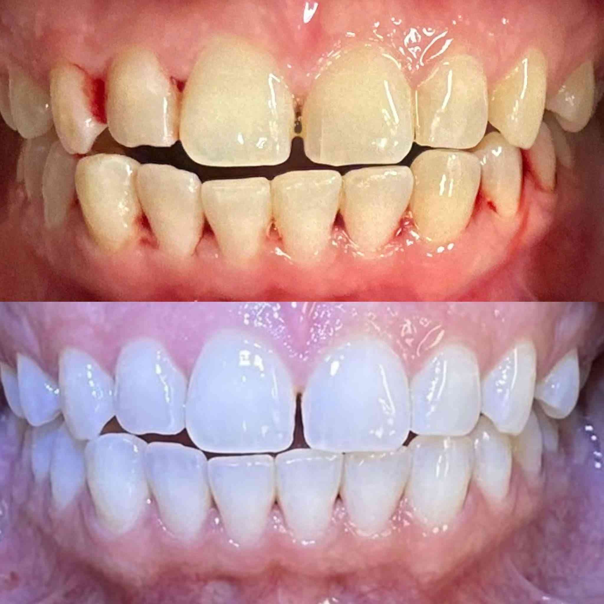 🎉 أسبوع تبييض الأسنان المجاني 🎉
لا تفوّتوا الفرصة! 😍
باشروا بالحجز من هسه 📲

📍 العنوان: داخل مجمع بسماية السكني
🏢 بناية دار المعرفة – عمارة مطعم سندريلا

📞 للحجز والاستفسار:
***********

🔥 وعروض جديدة ومميزة بانتظاركم!
⏰ انتظروها اليوم العصر… تنزل قريباً 👀✨

🦷 عيادة الزين لطب الأسنان — ابتسامتك تهمنا 🤍 داخل مجمع بسمايه السكني  بنايه دار المعرفه.       عماره مطعم سندريلا عياده الزين للاسنان الاسنان

