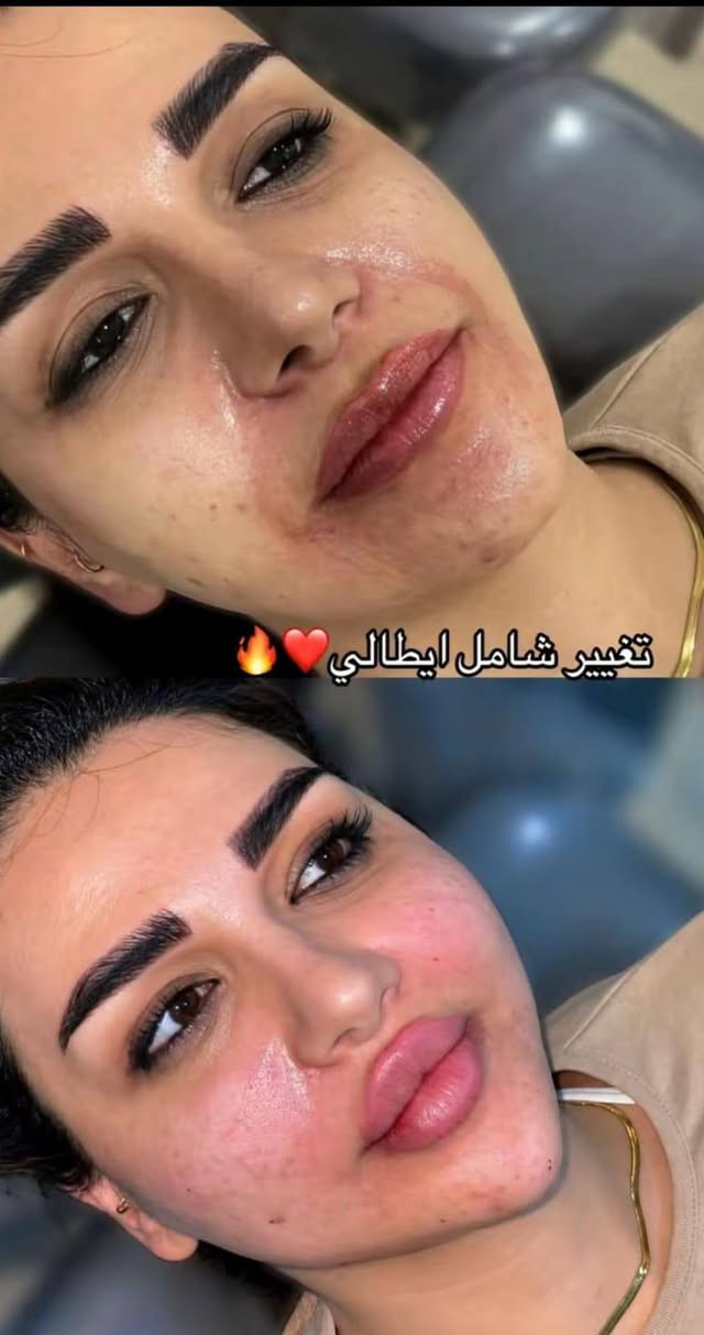 فيلر السيسي • تغيير شامل • عروض محدودة