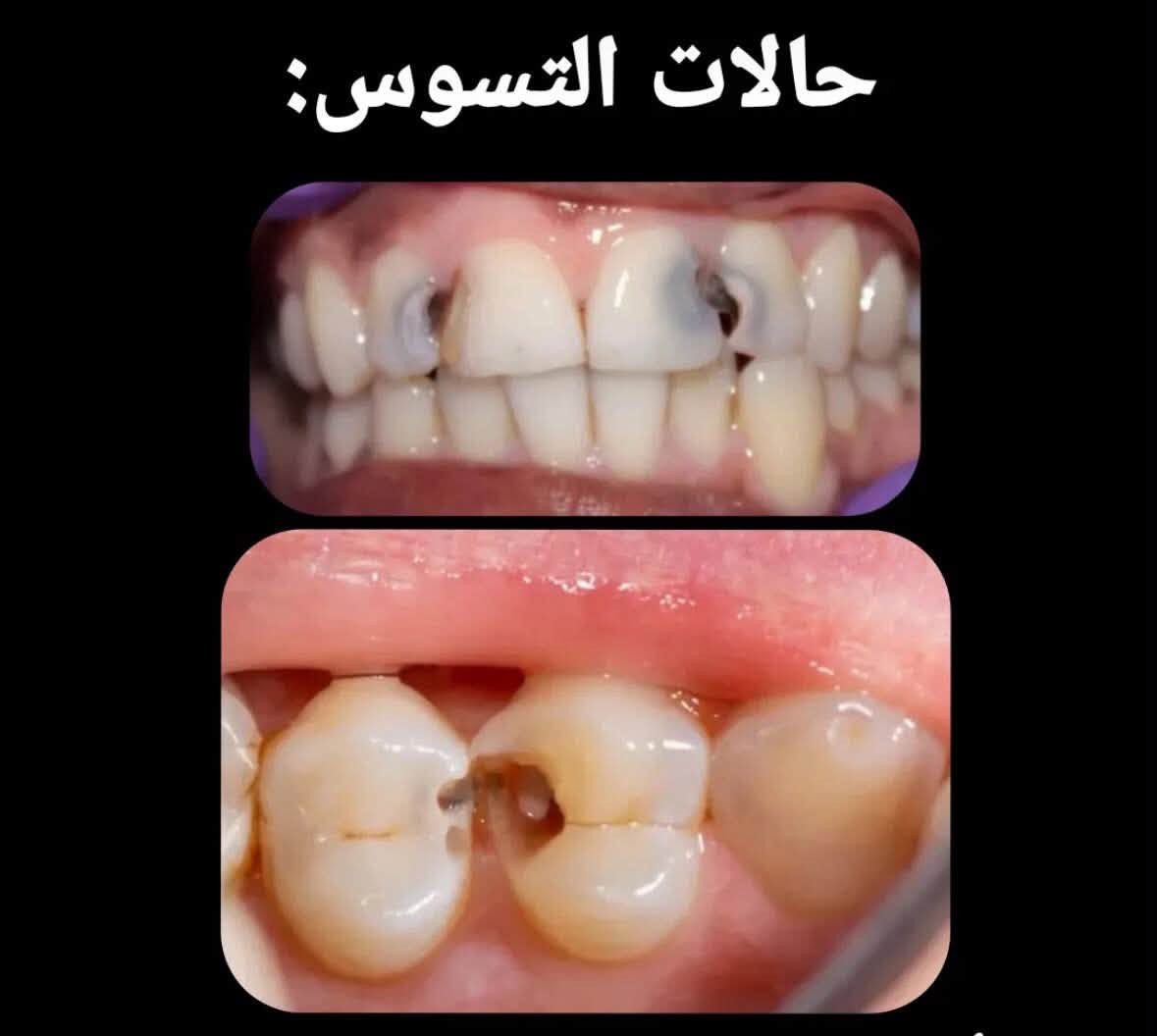 علاج مجاني • قلع أسنان • حشوات جذور