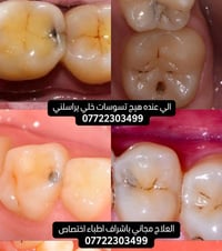 علاج أسنان مجاني • حشوات ضوئية • البصرة الجبيلة