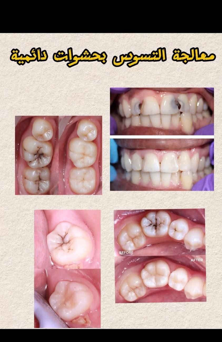 السلام عليكم الي محتاج قلع اسنان او تنظيف او حشوات ضوئية او تركيب طقم متحرك راح يكون العلاج بشكل مجاني وتحت اشراف اطباء اختصاص في محافظة البصرة في عيادات الكنوز التعليمية في الجبيلة للتواصل :
حساب الانستكرام Zainab.razzaqi 
للتواصل واتساب : ***********

نص مكتوب في الصور:
- تنظيف الاسنان وازالة التكلسات
- معالجة التسوس بحشوات دائمة BEFORE AFTER
- تعويض الاسنان المفقودة باطقم جزئية متحركة
- قلع الاسنان وبقايا الجذور التالفة