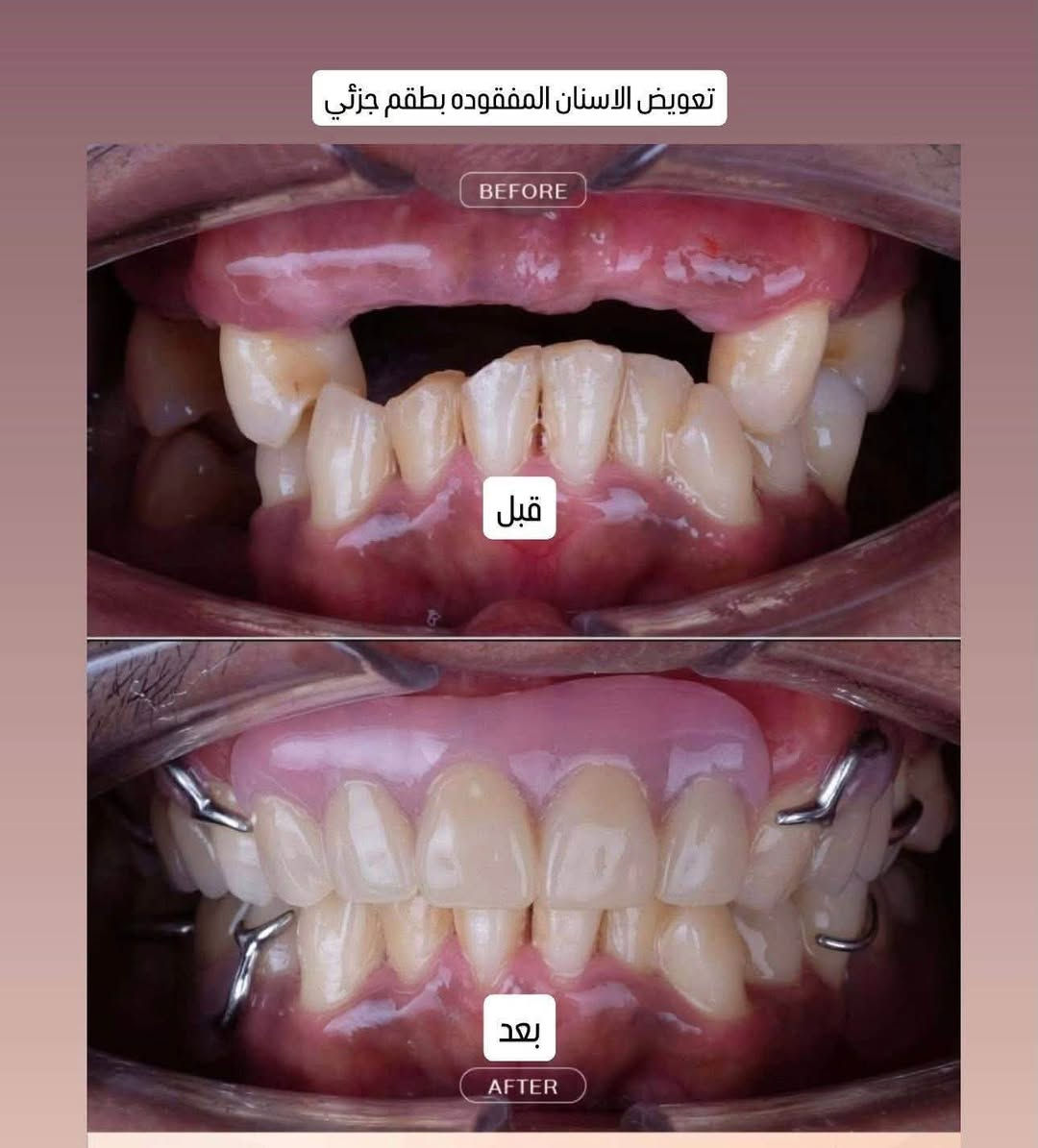 اهلنا في محافظة كربلاء 📌📌📌

عالج اسنانك بشكل مجاني بالكامل (عدا الطقم بسعر رمزي جداً ) العلاجات المتوفرة حالياً:
1-حشوات بيضاء لجميع الاسنان المتسوسة 
2-حشوات جذور للاسنان الامامية
3-علاج اسنان الاطفال وحمايتها من التسوس 
4- قلع الاسنان التالفة للكبار والاطفال
5- قلع اسنان العقل سواء فوق او تحت اللثة(جراحي)
6-اشعة للسن 
7-اشعة للفكين بالكامل ثنائية وثلاثية الابعاد ومفصل الفك 
8-اشعة نوع خاص للتقويم
9- علاج تقرحات الفم واللثة وما حول الفم
10-تنظيف الاسنان من التكلسات وازالة التصبغات (نتيجة التدخين وغيرها من الاطعمة والمشروبات)
11-طقم جزئي 
12-طقم كامل للاسنان 

رقمي للتواصل*********** 
حساب الانستاغرام لتوثيق الحالات i6-40 
العنوان كربلاء -حي الموظفين
