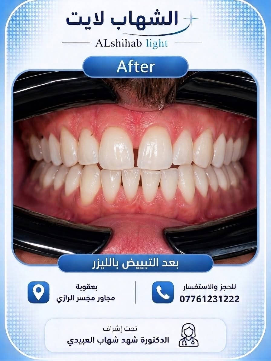 � حالة اليوم | تنظيف الأسنان وإزالة التصبغات ✨

مراجعنا اليوم كان يعاني من تراكم التصبغات والبقع على الأسنان، وتم إجراء جلسة تنظيف احترافية وإزالة التصبغات للحصول على أسنان أنظف ومظهر أكثر صحة، مع الحفاظ على اللون الطبيعي للأسنان بدون مبالغة 🤍

✨ ملاحظة: لمن يرغب بدرجة أفتح من لون الأسنان الطبيعي، تتوفر لدينا أيضاً خدمة تبييض الأسنان بالليزر بعد تقييم الحالة وتحديد الخيار المناسب.

لأن النتيجة الحلوة مو شرط تكون مبالغ بيها…
الجمال الحقيقي بالنتيجة الطبيعية والمصداقية. 🦷🤍

📍 بعقوبة – مجاور مجسر الرازي
📞 للحجز والاستفسار: ***********

الشهاب لايت | ALshihab light
تحت إشراف الدكتورة شهد شهاب العبيدي

#تنظيف_الأسنان #إزالة_التصبغات #تبييض_الأسنان #تبييض_بالليزر #تصبغات_الأسنان صحة_الأسنان ابتسامة_صحية العناية_بالأسنان طب_الأسنان عيادة_أسنان طبيب_أسنان تنظيف_اسنان اسنان_بعقوبة بعقوبة ديالى العراق DentalCleaning TeethCleaning LaserTeethWhitening DentalClinic HealthySmile OralHealt
