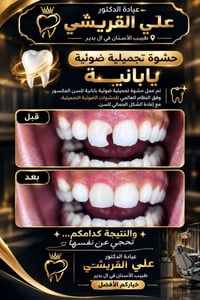 حشوة تجميلية • عيادة القريشي • آل بدير
