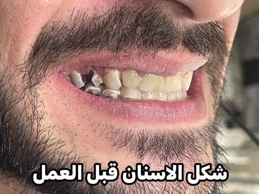 ابتسامة هوليود • زاركون ايماكس • ضمان مدى الحياة