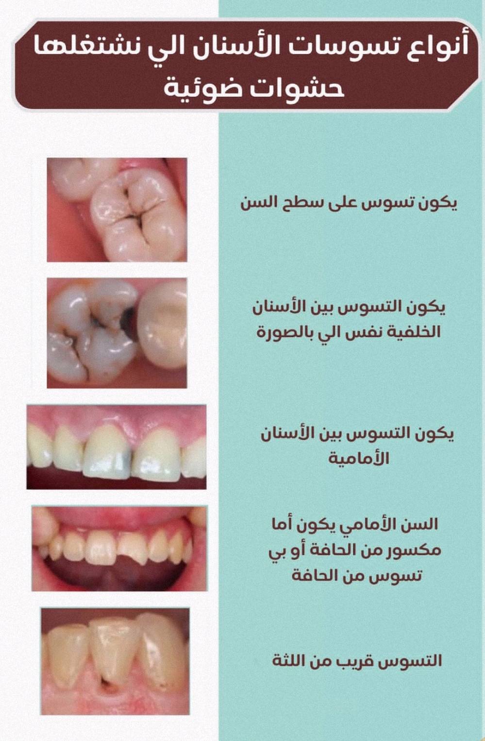 نبدأ باستقبالكم لإجراء علاجات الأسنان مجانًا ✨
وتحت إشراف كادر تدريسي مميز 👨🏻‍⚕️

🔹 الحشوات التجميلية
🔹 تنظيف الأسنان
🔹 قلع الأسنان
🔹 تعويض الأسنان المفقودة

📍 داخل عيادات جامعة الهادي
📌 الدورة – شارع 60

للحجز والاستفسار:
📞 ***********