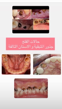عيادات الجامعة الوطنية • قلع سن • علاج مجاني