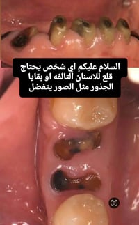 قلع أسنان • جسر متحرك • تنظيف وتبييض