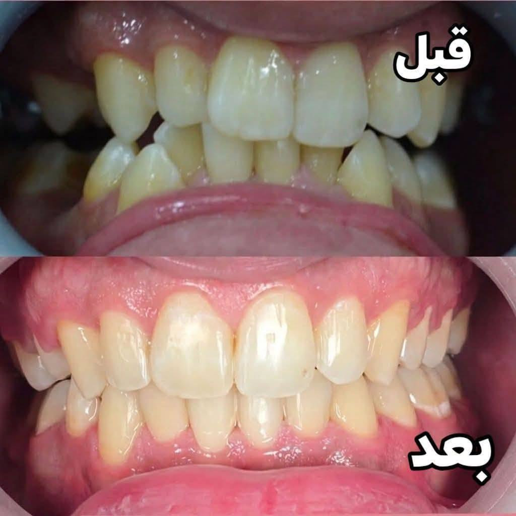 في عيادة البدر لطب وزراعة وتقويم الأسنان  
 نقدم لكم خدمات متكاملة بأحدث التقنيات وعلى أيدي أطباء مختصين، حتى تحصلون على ابتسامة أجمل وإطلالة أكثر إشراقًا بثقة وراحة.

🦷 خدمات الأسنان:  "الدكتور مصطفى محمد البدر "
• زراعة الأسنان
• تقويم الأسنان (تقليدي وشفاف)
• تجميل الابتسامة (فينير وابتسامة هوليود)
• علاج العصب والحشوات
• تبييض الأسنان بالليزر

💉 خدمات التجميل:  الدكتورة د.شفق شلال "

• بوتوكس
• فيلر
• توريد الشفايف
• إبرة النضارة
• بلازما للشعر
• ميزوثيرابي
• علاج الكلف والتصبغات 

    🕧متواجدين يوميا  من الساعة 4 إلى الساعة 8
    
📍 العنوان: البدير - مجمع دعاء شاكر البديري
📞 للحجز والاستفسار: ***********
ننتظركم في عيادة البدر... لأن اهتمامنا بتفاصيل ابتسامتكم وجمالكم يبدأ من أول زيارة. ✨

#زراعة_الأسنان #تقويم_الأسنان #ابتسامة_هوليود #تبييض_الأسنان  #بلازما_للشعر #البدير #الديوانية
