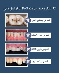 حشوات ضوئية دائمة • تسوس بين الأسنان • مجانا