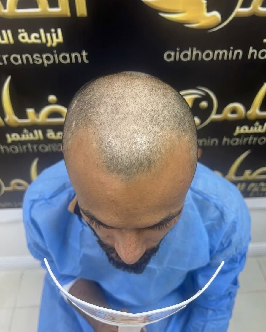 عدد البصيلات؟ مفتوح ✨
الكثافة؟ 100% ✨
النتيجة؟ شعر طبيعي يندمج مع شعرك الأصلي دون فرق.

في الضامن، هدفنا مو مجرد تغطية الفراغات، هدفنا الوصول لأعلى كثافة ممكنة تناسب حالتك وتمنحك مظهراً طبيعياً وثقة أكبر. 💙�

🔷العنوان: 
كربلاء المقدسة: الاسكان _ خلف القنصلية الايرانية _ مجمع العيادة الاولى
***********
بغداد: الاعظمية - ساحة عنتر -مستشفى دجلة الاهلي⁩⁩
***********

#الضامن_لزراعة_الشعر #زراعة_الشعر #كثافة_100 #نتائج_طبيعية #بغداد_كربلاء
⁩⁩⁩

نص مكتوب في الصور:
- الضامن لزراعة الشعر
- قبل
- بعد
- الضامن لزراعة الشعر aldhamin hairtransplant
- كربلاء - الاسكان- خلف القنصلية الايرانية- مجمع العيادة الاولى
- (***********)
- بغداد - الاعظمية - ساحة عنتر- مستشفى دجلة الاهلي
- (***********)