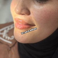 فلر شفاه • نتائج طبيعية • د ساره عدنان