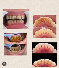 تنظيف اسنان • تكلسات • علاج مجاني