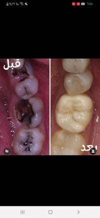 تنظيف اسنان • تكلسات • مجاني