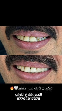 لا توجد تفاصيل  نص مكتوب في الصور: - تركيبات ثابته لسن مفقود 🔥🤍 - الام...