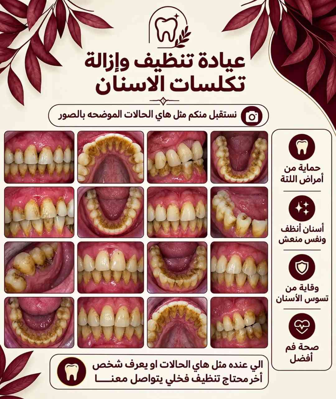 قال تعالى 
﴿وَمَا تَوْفِيقِي إِلَّا بِاللَّهِ ۚ عَلَيْهِ تَوَكَّلْتُ وَإِلَيْهِ أُنِيبُ﴾

بعد سنوات من الدراسة والتعلم النظري والعملي، أبدأ مرحلة جديدة ومهمة في مسيرتي كطالب طب أسنان: العيادات السريرية.
خلال هذه المرحلة سأشارككم جانبًا من الحالات والخدمات التي نستقبلها في العيادات السريرية، بالإضافة إلى معلومات ونصائح بسيطة تساعدكم على الاهتمام بصحة الفم والأسنان.
📍 جامعة العين العراقية – المستشفى التعليمي لكلية طب الأسنان
إذا كنت بحاجة إلى إحدى الخدمات التي نعلن عنها، يمكنك التواصل معي عبر الرسائل لمعرفة التفاصيل ومواعيد الاستقبال.

#الناصرية #طب_اسنان #العراق #اكسبلور

نص مكتوب في الصور:
- د. الحسن علي العبودي طالب طب أسنان تنظيف الأسنان من التصبغات و إزالة التكلسات معالجة الأسنان بالحشوات الضوئية (التجميلية) قلع الأسنان والجذور التالفة تعويض الأسنان المفقوده بطقم جزئي متحرك الموقع شارع النيل _ حي الشهداء _ جامعة العين العراقية _ المستشفى التعليمي لكلية طب الأسنان ملاحظة وذلك بأشراف نخبة من الأطباء المختصين مع إستخدام أحدث الأجهزة و المواد لضمان أفضل النتائج و العلاج مجاني بالكامل alhassanalii19 *********** ***********
- عيادة تنظيف وإزالة تكلسات الاسنان نستقبل منكم مثل هاي الحالات الموضحه بالصور حماية من أمراض اللثة أسنان أنظف ونفس منعش وقاية من تسوس الأسنان صحة فم أفضل الي عنده مثل هاي الحالات او يعرف شخص آخر محتاج تنظيف فخلي يتواصل معنا
- عيادة قلع الأسنان نستقبل منكم مثل هاي الحالات الموضحة بالصور سن متسوس سن مكسور سن متآكل بشدة سن متحرك تسوس عميق الأسنان المسببة للزحام سن مصاب بالعدوى تسوس كبير سن غير قابل للترميم فشل علاج العصب سن لبني متبقي سن تالف لا يمكن ترميمه حماية من أمراض اللثة أسنان أنظف ونفس منعش وقاية من تسوس الأسنان صحة فم أفضل
- عيادة الحشوات التجميلية (الضوئية)
- نستقبل منكم مثل هذه الحالات الموضحة بالصور
- 1
- فئة (1)
- 2
- فئة (2)
- 3
- فئة (3)
- 4
- فئة (4)
- 5
- فئة (5)
- عيادة التعويضات السنية المتحركة
- (في الفكين العلوي و السفلي)
- صحة فم أفضل
- وقاية من تسوس الأسنان
- أسنان أنظف ونفس منعش
- حماية من أمراض اللثة