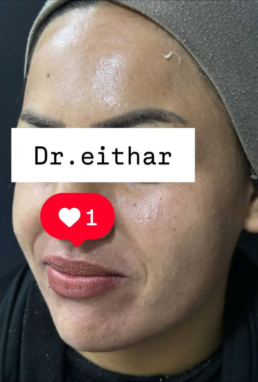 كونتور الوجه بالفلر  (لفتنك وجنات  واصداغ وتدوير الفك والذقن ونظاره وشفة ) 🔥🔥
لاحضو الفرق بالذقن ومنطقه الفك والوجنات شكد تغير الشكل🔥
عروووض للكادر التدريسي والخريجات والموظفات والعروسات  ثبتتهه الكم بالستوري بالهايلايت وببوست اعلى الصفحة ✨✨

د.ايثار سامي عبد الامير
واسط الكوت الهوره مجمع القبطان طابق اول 

الحجز***********
