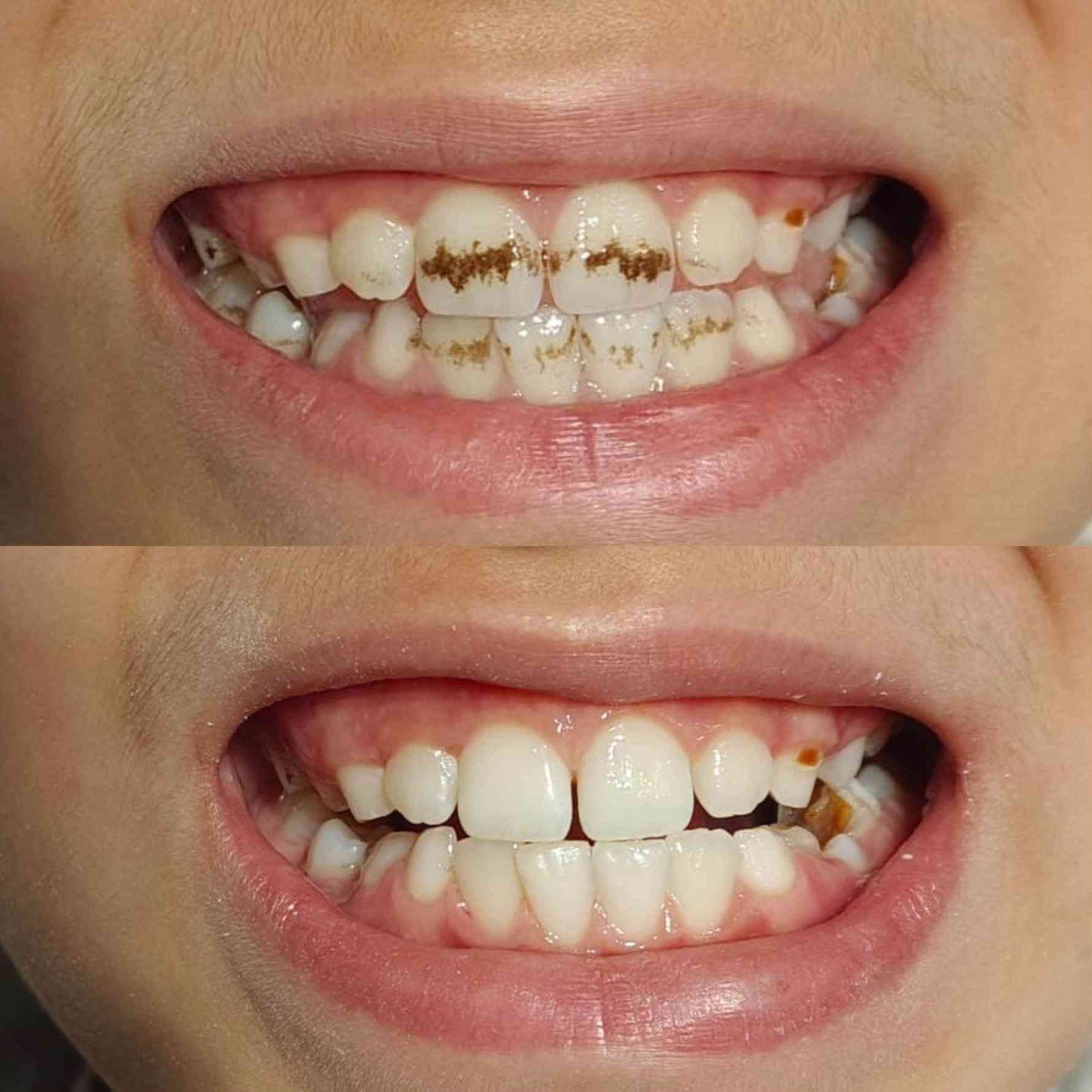 من حالات طب الاسنان بعيادتنا 🤍🦷✅ تنظيف الاسنان لطفل بسبب اهمال التفريش وحالة تبييض اسنان بالليزر بجلسة واحدة

عيادة الدكتورة مروة محمد التميمي

🏥الديوانية العروبة-شارع المتحف-مجاور مطعم كودو كودو
📞رقم الحجز ***********

متوفر نظام التقسيط على الماستر كارد

