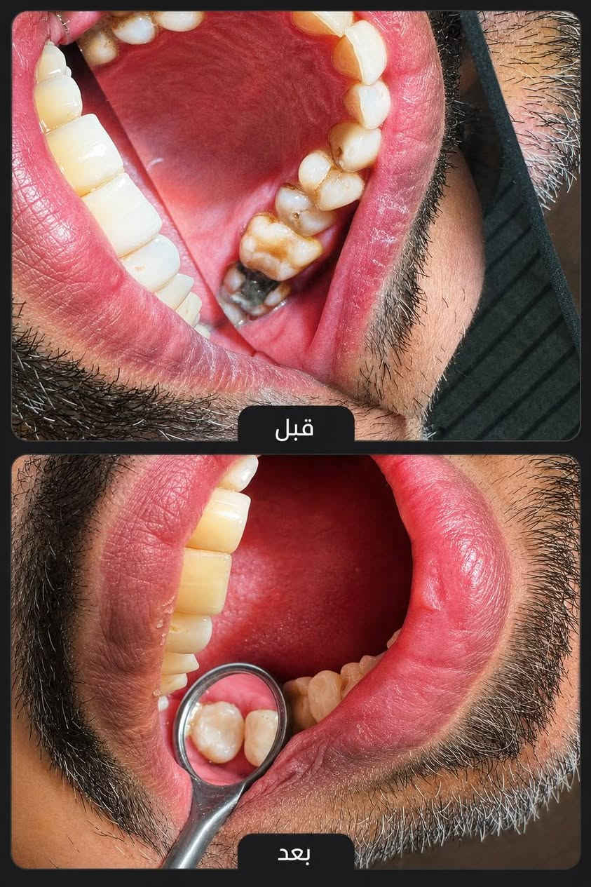 عمل دكتورة فاطمة محمد عارية 🌿🌹
عيادات الاسنان  الدكتور محمد فتين الدريعي 👑🦷🤍
متواجدون طيلة ايام الاسبوع حتى يوم الجمعة و ع مدار ٢٤ ساعة للحالات الطارئة 
د. محمد فتين الدريعي 
د. عفراء محسن ناصر شنيع
د. فاطمة محمد عارية 
 رقم الحجز او لاستفسار //*********** علماً يوجد واتساب 
صحة وعافية للجميع 🌹👑🌿👨‍⚕️
