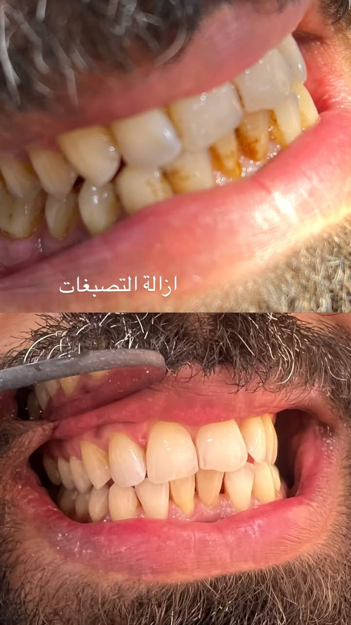 عيادات جامعة المعارف • طقم اسنان متحرك • تنظيف اسنان