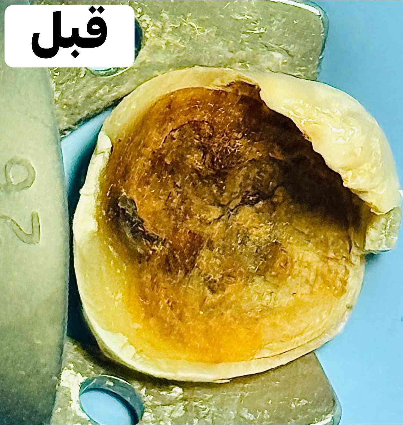 مو كل سن متهالك يحتاجله قلع 🔥

انقاذ سن متهالك من القلع ..
بعد عمل حشوه الجذر و تغليفه بالتركيبات المختبريه (زاركون) عاليه الجمال للمحافظه على عمليه المضغ والأكل بصوره طبيعيه .🦷

نيكست لطب وتجميل الأسنان 
ذي قار / القلعه / شارع الأطباء /مقابل مدرسه الربيع 
و مجاور صيدليه النبراس (مجمع الكواظمه /الطابق الثاني )
للحجز والأستفسار مراسله الصفحه 
او الأتصال على الرقم ***********
