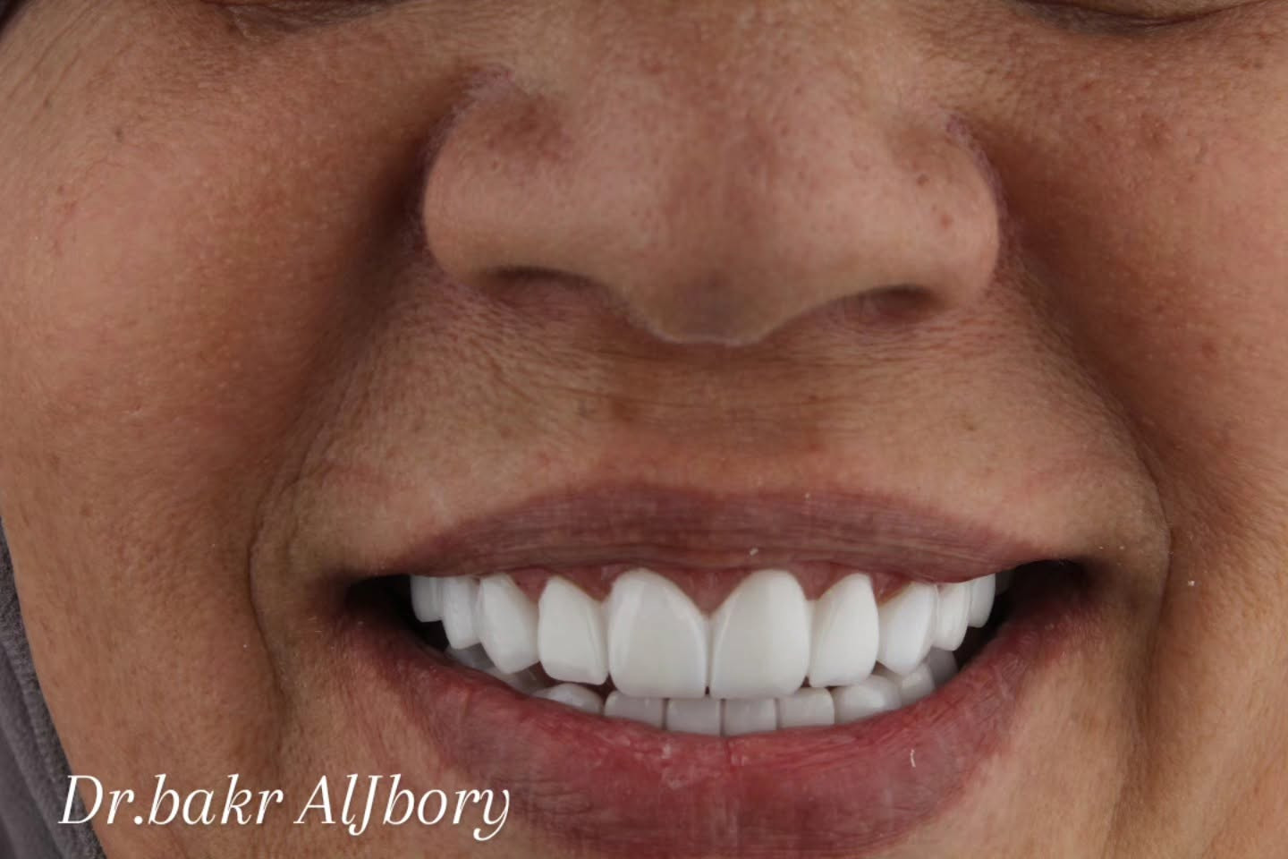 ابتسامة هوليوود • د بكر الجبوري • تجميل اسنان