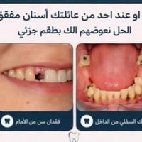 طقم جزئي • اسنان مفقودة • فك علوي و سفلي