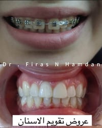 د. فراس حمدان • تقويم أسنان • تبييض بالليزر